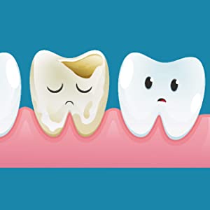 cemento dentale provvisorio in caso di otturazione saltata per dente cariato