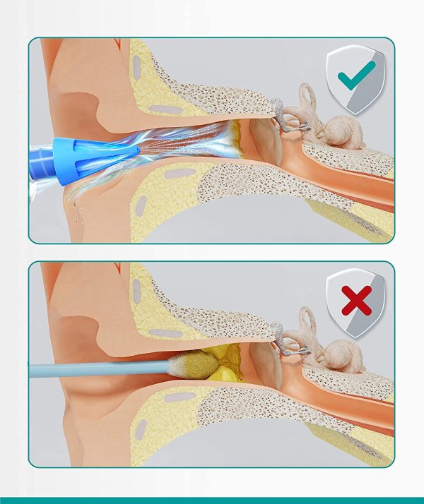 Medi Grade Kit Siringa Pulisci Orecchie ?C Siringa per Tappi Orecchie con 3 Punte a Getto Quadruplo ?C Kit Medico per Pulizia Orecchie di Uso Domestico - Migliora L??udito e la tua Salute Naturalmente - immagine 5